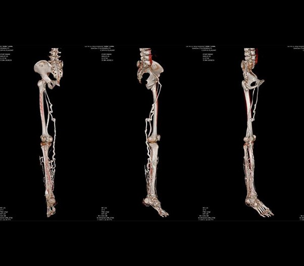 Lower Limb CTV